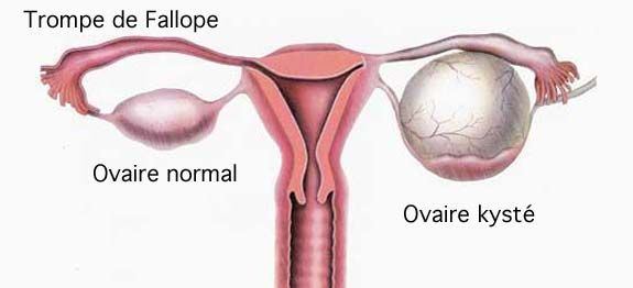 Comment savoir si j'ai des problèmes de kystes ovariens