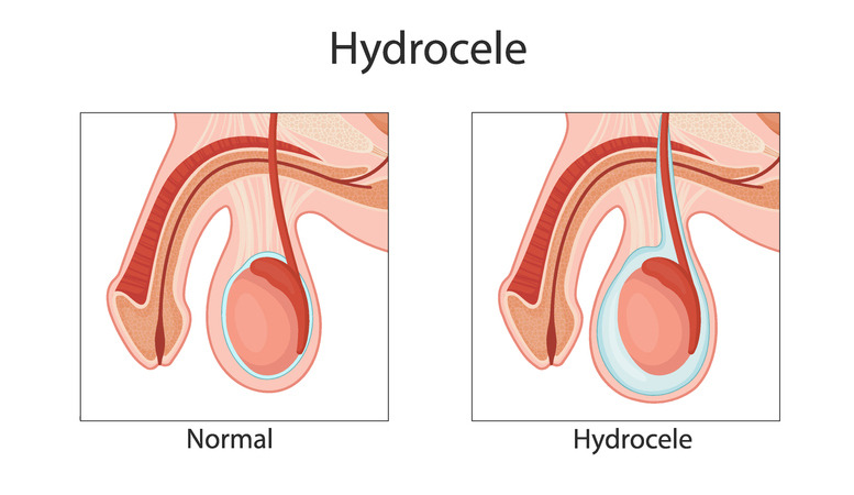 l’hydrocèle testiculaire