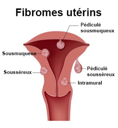 traitement naturel pour combattre les fibromes utérins